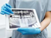 Ezeket érdemes tudnod a fogászati implantátumról fogászati implantátum