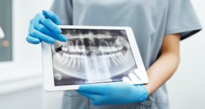 Ezeket érdemes tudnod a fogászati implantátumról fogászati implantátum