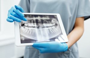 Ezeket érdemes tudnod a fogászati implantátumról fogászati implantátum