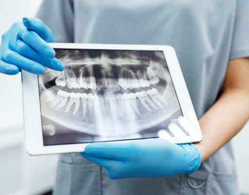 Ezeket érdemes tudnod a fogászati implantátumról fogászati implantátum