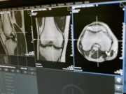 Hogyan kezelhető a kattogó térd? térd