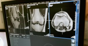 Hogyan kezelhető a kattogó térd? térd