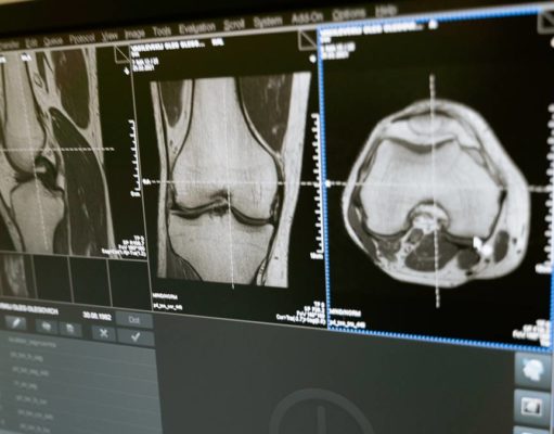 Hogyan kezelhető a kattogó térd? térd