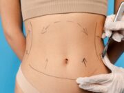 Hasplasztika – kiknek ajánlott, meddig tart, mik a várható eredmények? Hasplasztika