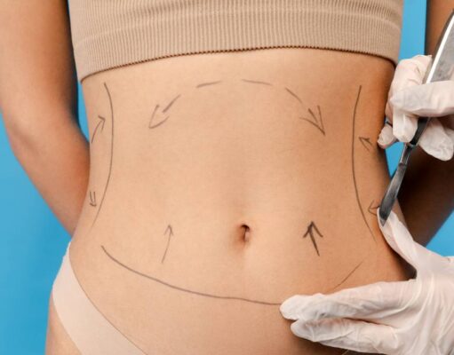 Hasplasztika – kiknek ajánlott, meddig tart, mik a várható eredmények? Hasplasztika